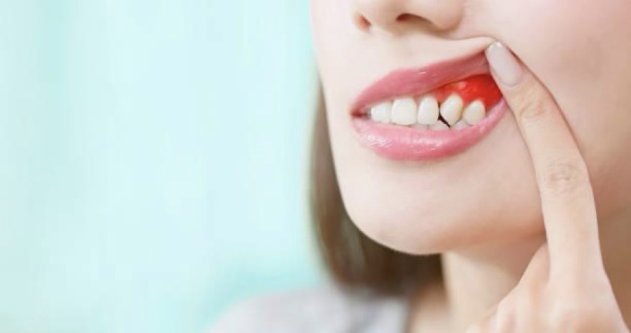 歯周病の初期サイン