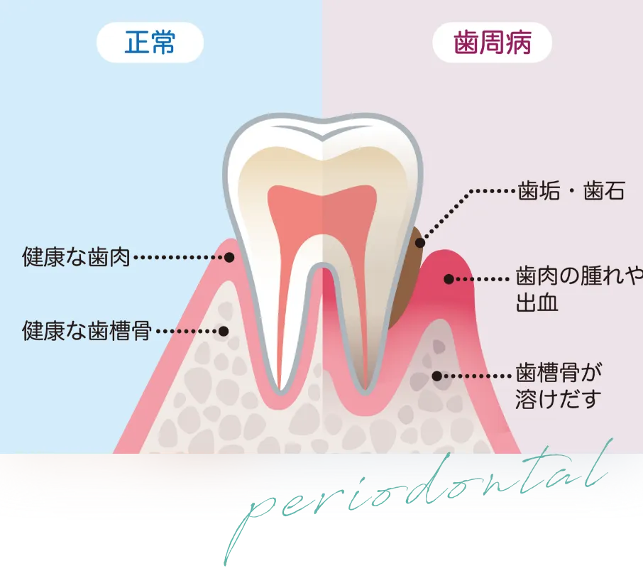 periodontal