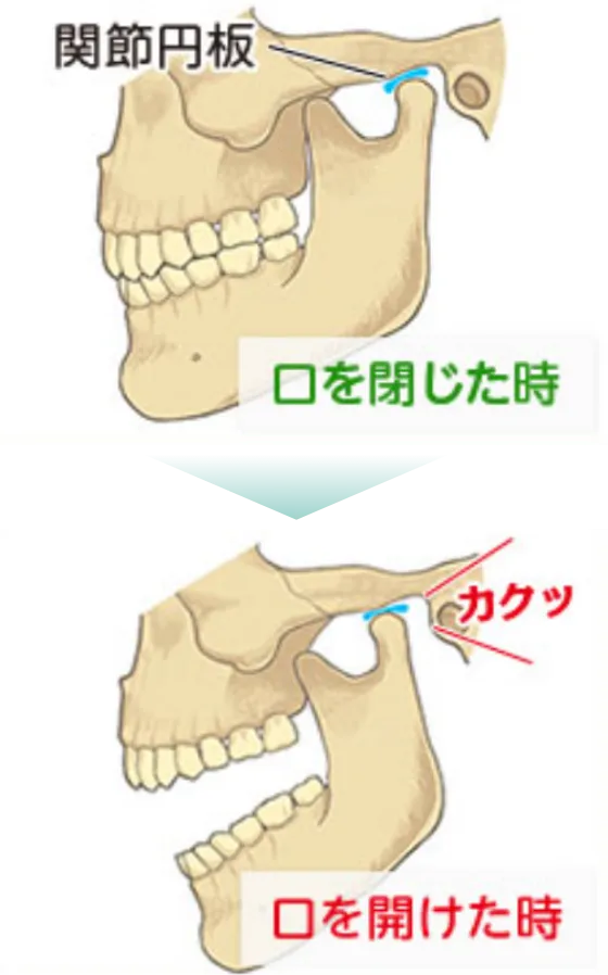 口を閉じたときと口を開けたときの関節円板の構図
