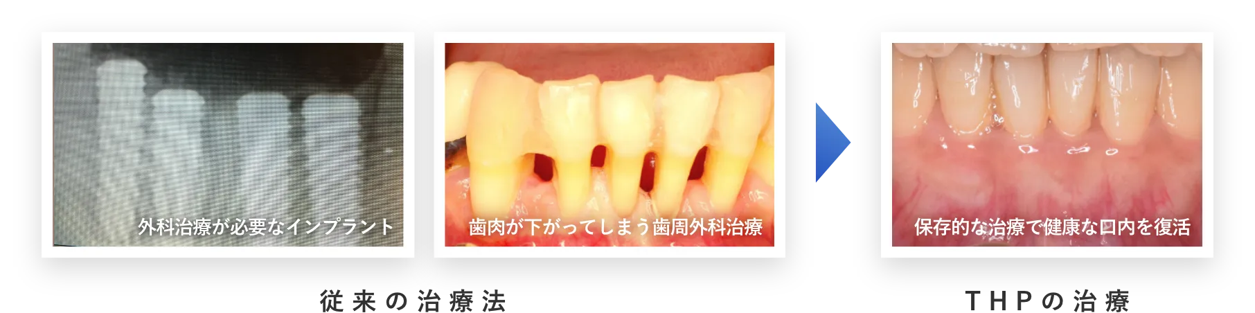 従来の治療法（左側：外科治療が必要なインプラント、右側：歯肉が下がってしまう歯周外科治療）。THPの治療（保存的な治療で健康な口内を復活）。